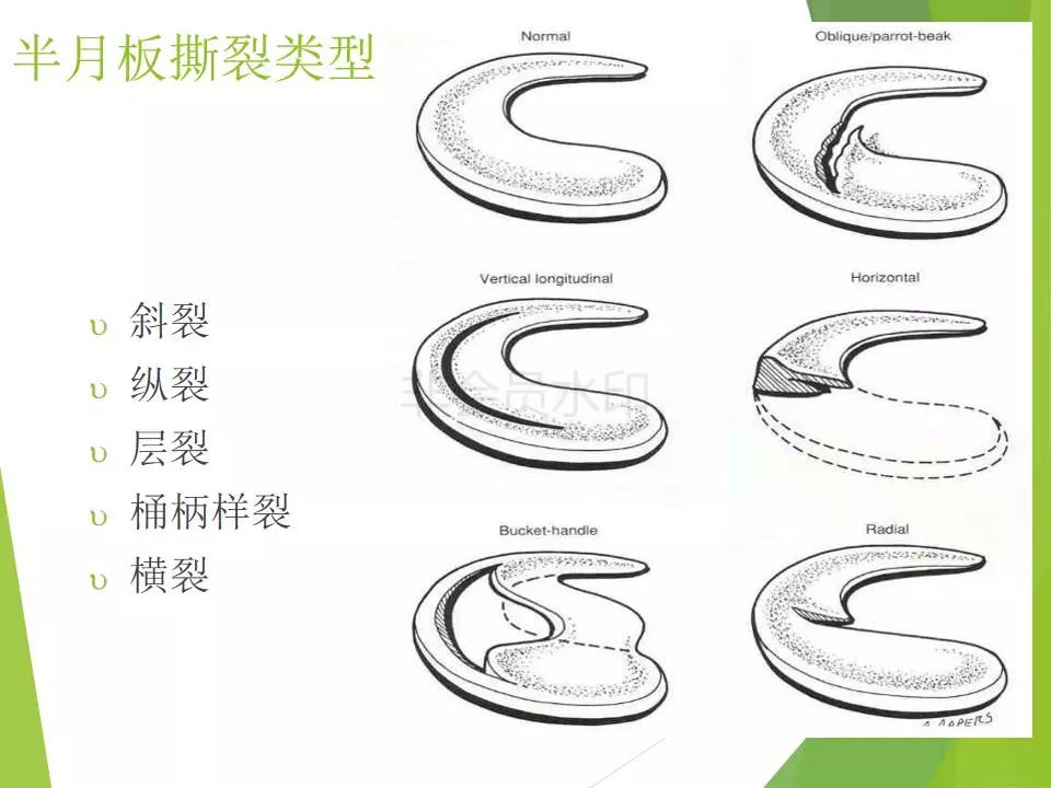 半月板损伤关节内及关节外各种缝合技术及应用