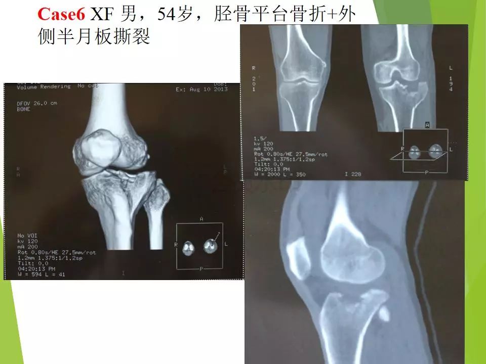 半月板损伤关节内及关节外各种缝合技术及应用