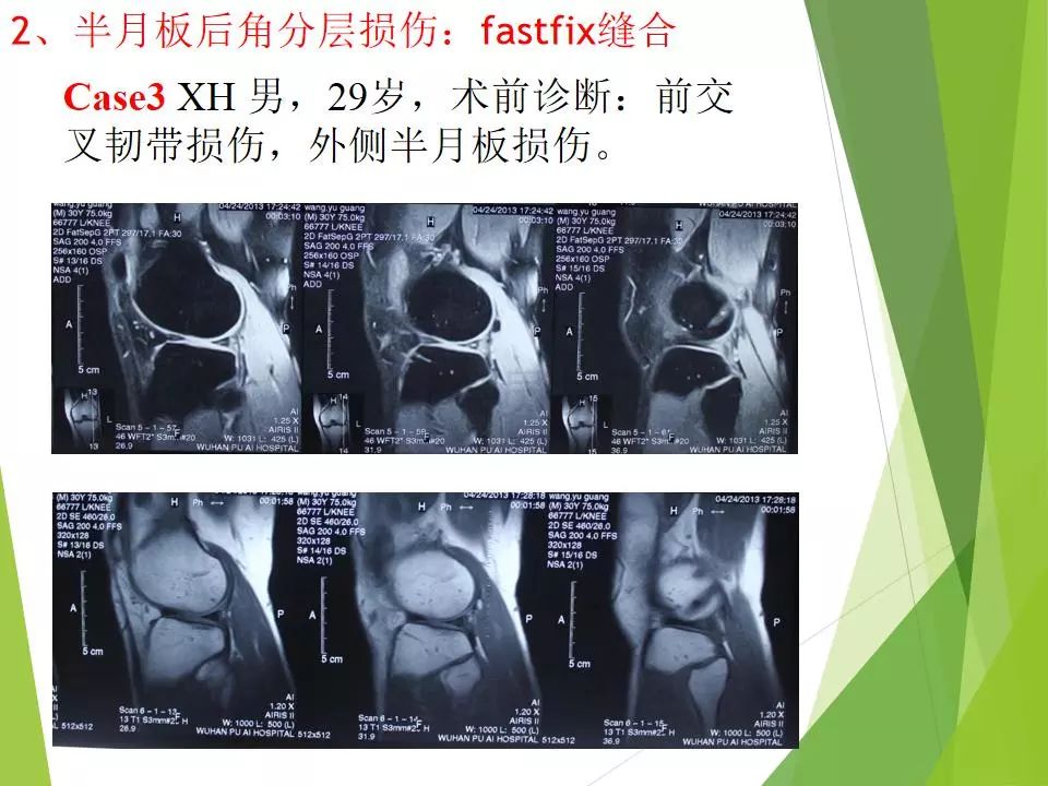 半月板损伤关节内及关节外各种缝合技术及应用