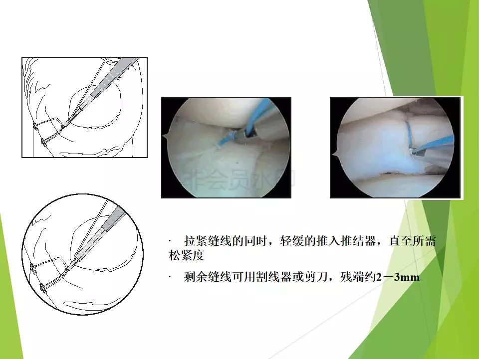半月板损伤关节内及关节外各种缝合技术及应用