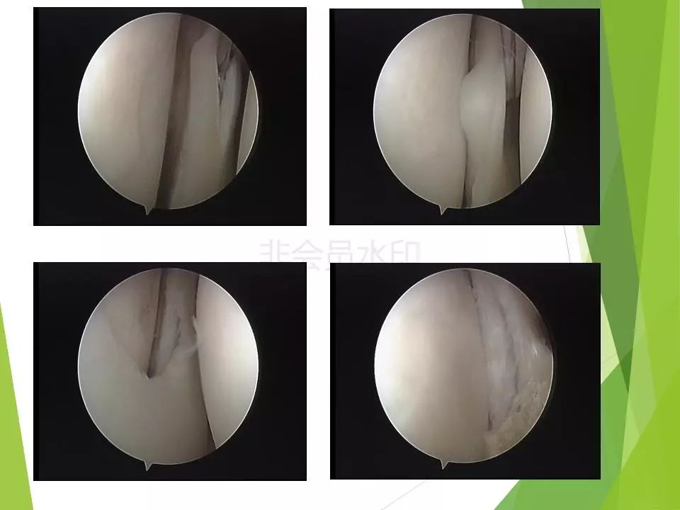 半月板损伤关节内及关节外各种缝合技术及应用