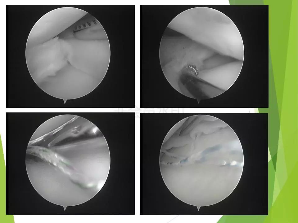 半月板损伤关节内及关节外各种缝合技术及应用