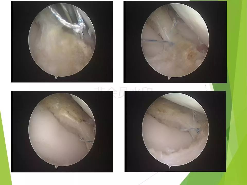 半月板损伤关节内及关节外各种缝合技术及应用