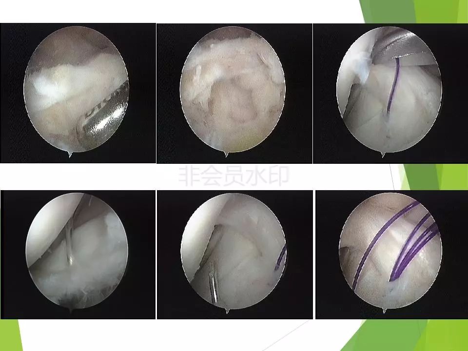半月板损伤关节内及关节外各种缝合技术及应用