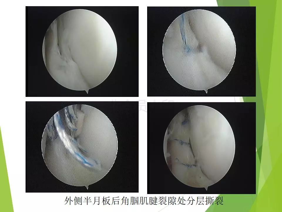 半月板损伤关节内及关节外各种缝合技术及应用