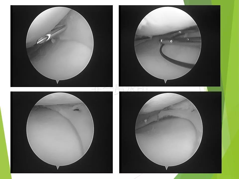 半月板损伤关节内及关节外各种缝合技术及应用