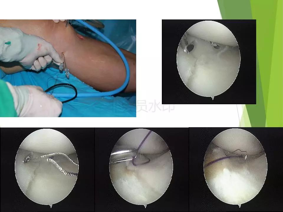半月板损伤关节内及关节外各种缝合技术及应用