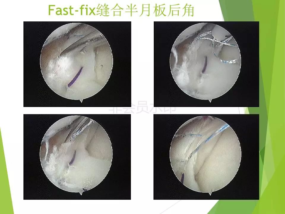 半月板损伤关节内及关节外各种缝合技术及应用