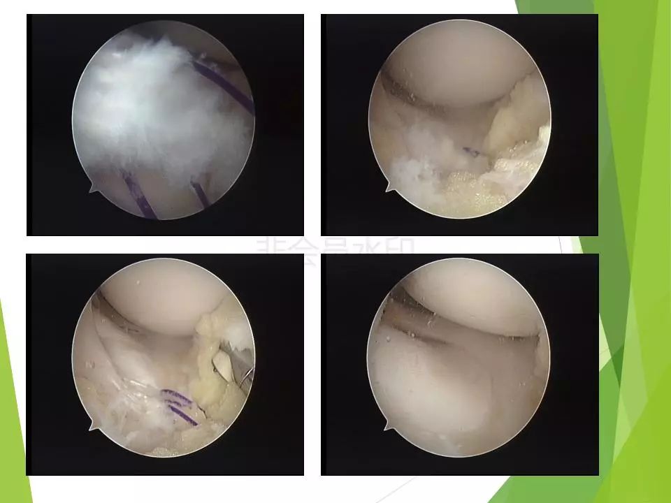 半月板损伤关节内及关节外各种缝合技术及应用