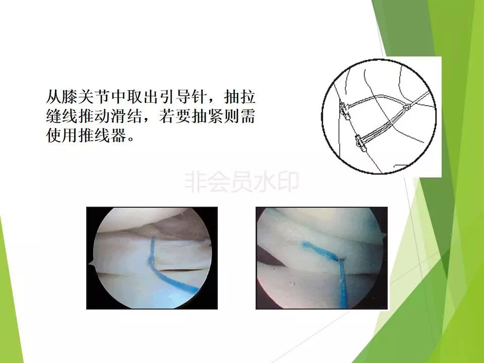 半月板损伤关节内及关节外各种缝合技术及应用