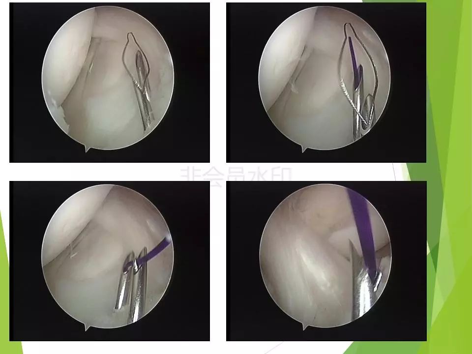 半月板损伤关节内及关节外各种缝合技术及应用