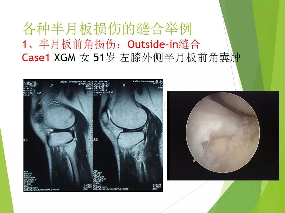 半月板损伤关节内及关节外各种缝合技术及应用