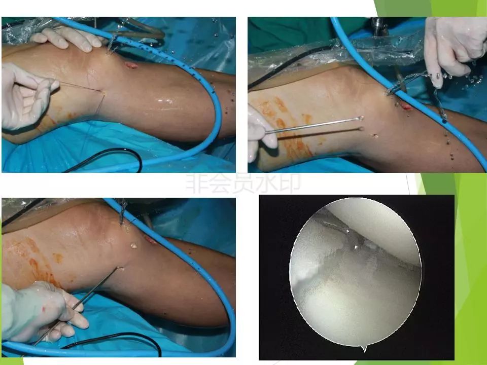 半月板损伤关节内及关节外各种缝合技术及应用