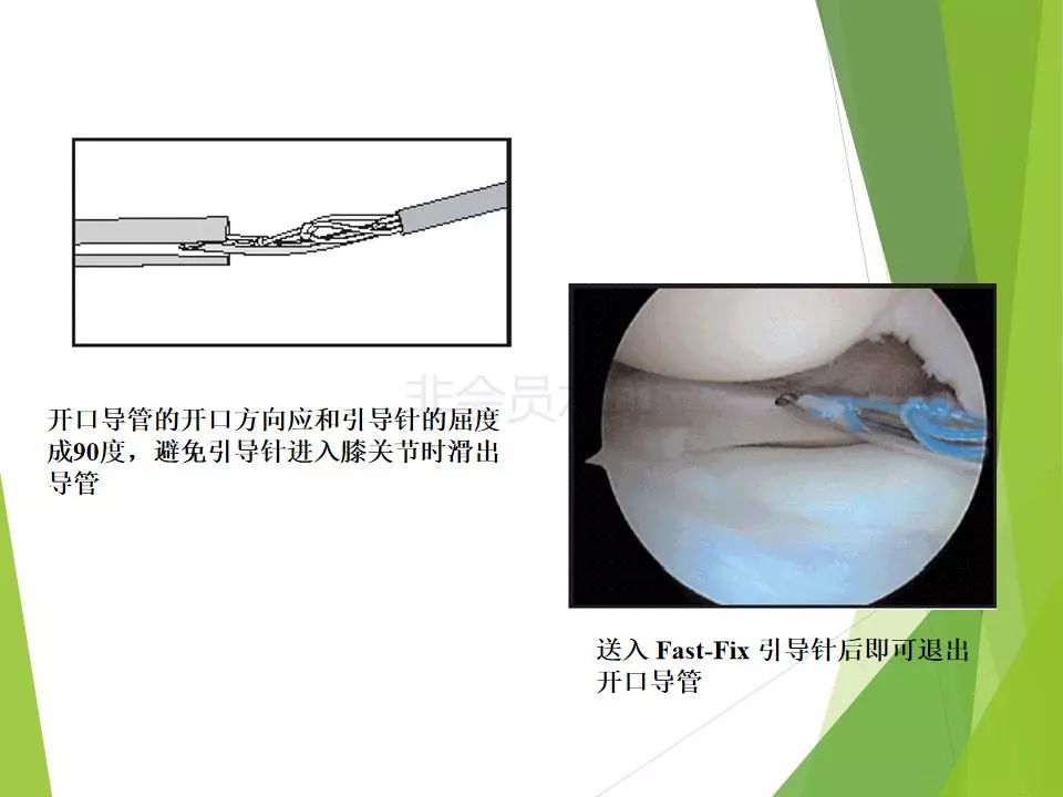 半月板损伤关节内及关节外各种缝合技术及应用