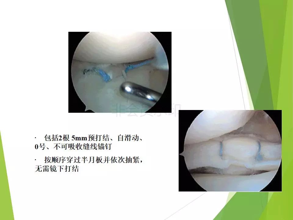 半月板损伤关节内及关节外各种缝合技术及应用
