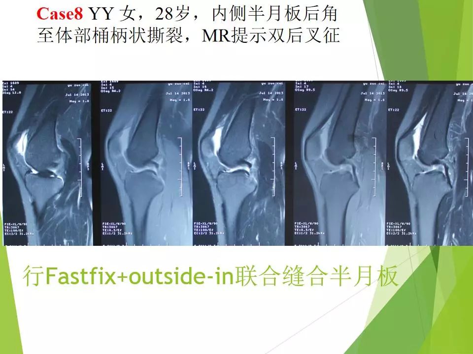 半月板损伤关节内及关节外各种缝合技术及应用