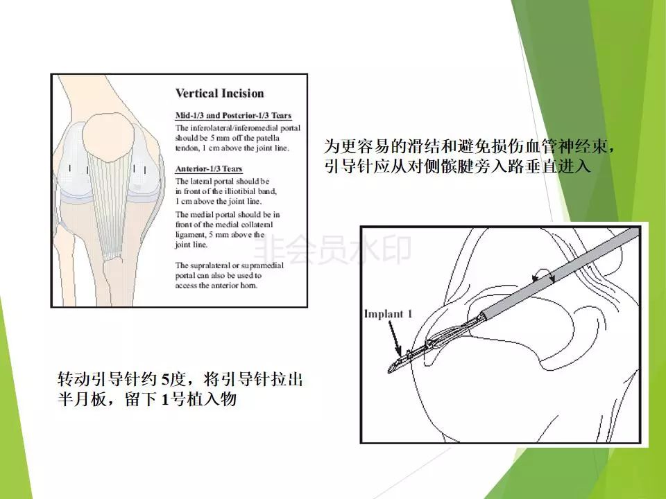半月板损伤关节内及关节外各种缝合技术及应用