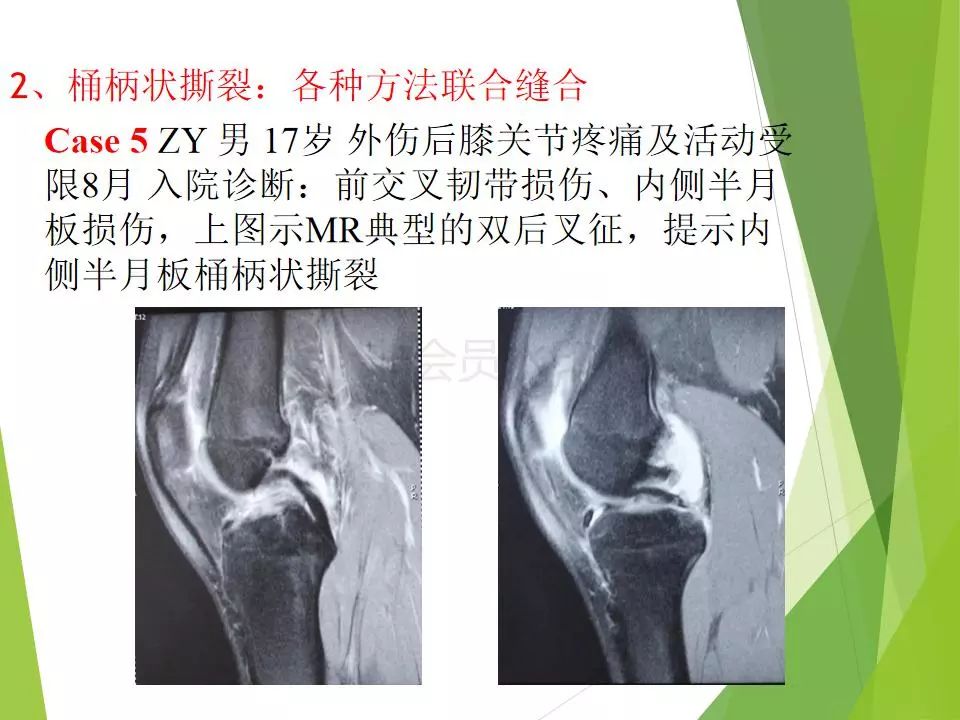 半月板损伤关节内及关节外各种缝合技术及应用