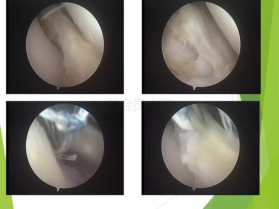 半月板损伤关节内及关节外各种缝合技术及应用