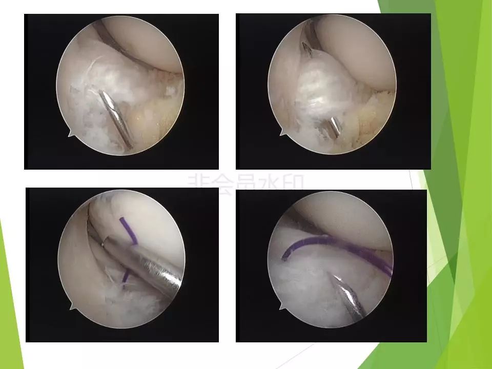 半月板损伤关节内及关节外各种缝合技术及应用