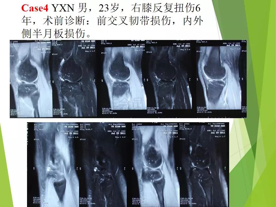 半月板损伤关节内及关节外各种缝合技术及应用