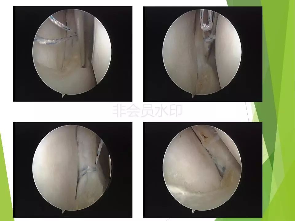 半月板损伤关节内及关节外各种缝合技术及应用