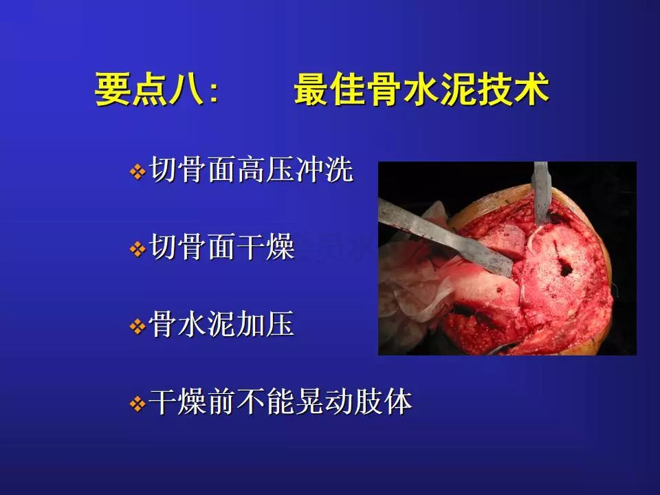 TKA手术操作要点，详细解析！