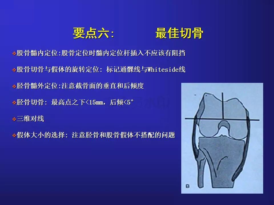 TKA手术操作要点，详细解析！