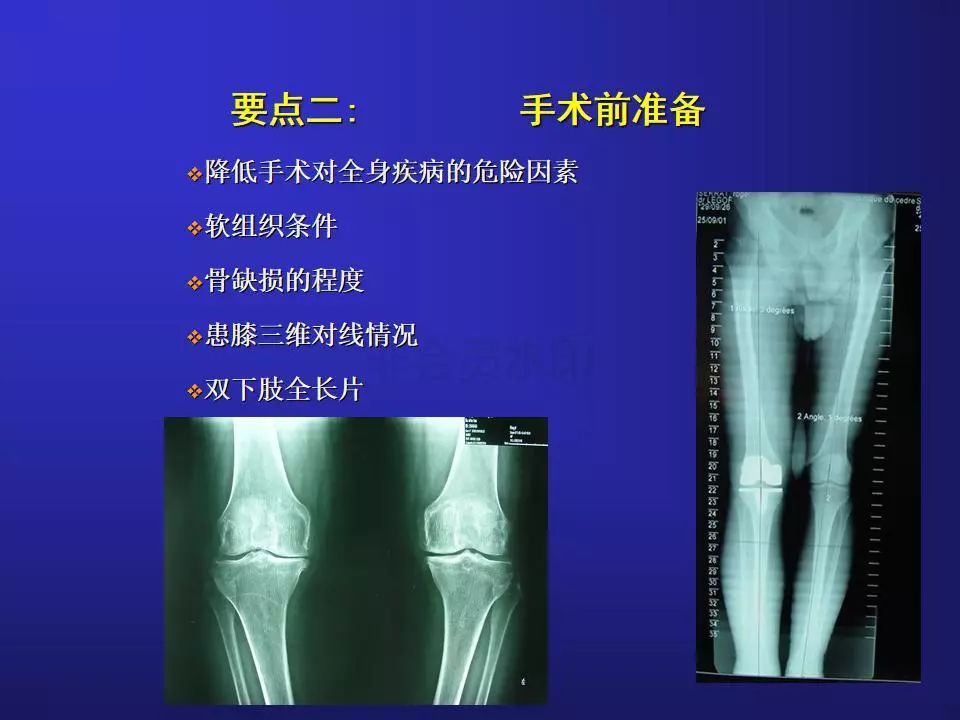 TKA手术操作要点，详细解析！