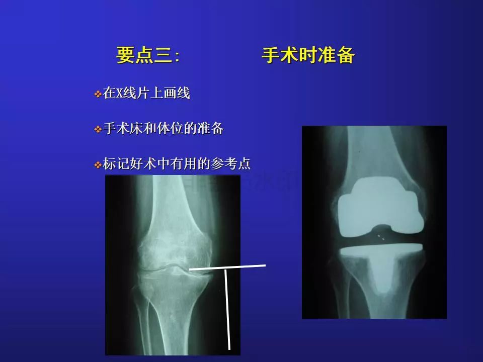 TKA手术操作要点，详细解析！