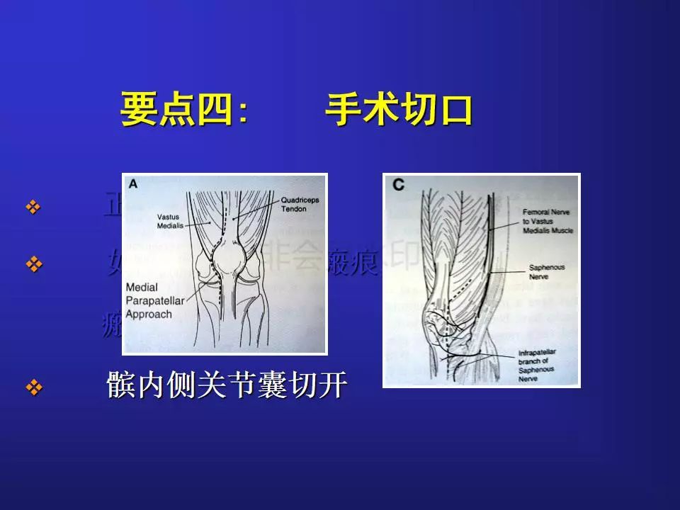 TKA手术操作要点，详细解析！