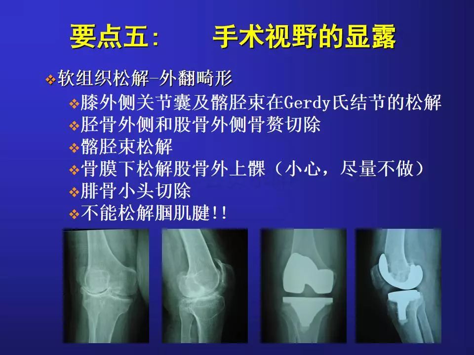 TKA手术操作要点，详细解析！