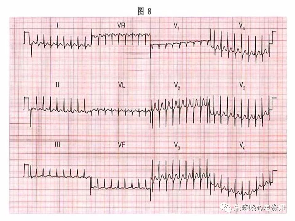 心电图危急值识别与诊断，看完我就收藏了！