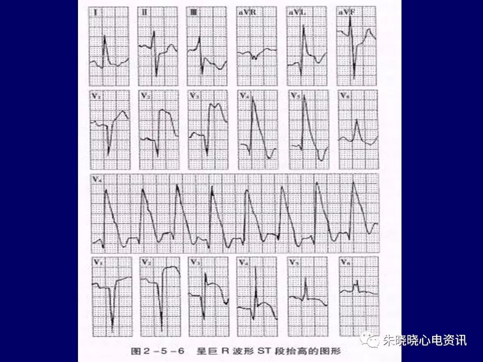 心电图危急值识别与诊断，看完我就收藏了！