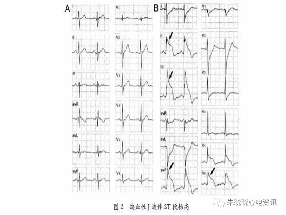 心电图危急值识别与诊断，看完我就收藏了！