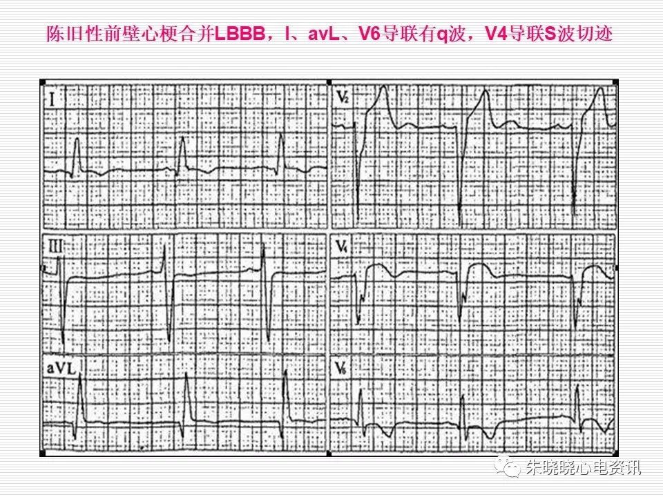 心电图危急值识别与诊断，看完我就收藏了！