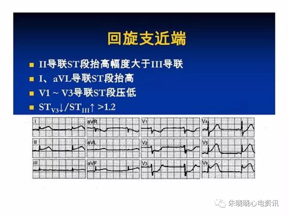 心电图危急值识别与诊断，看完我就收藏了！