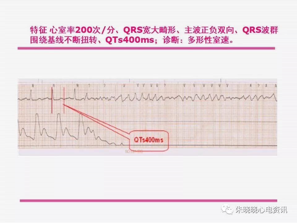 心电图危急值识别与诊断，看完我就收藏了！