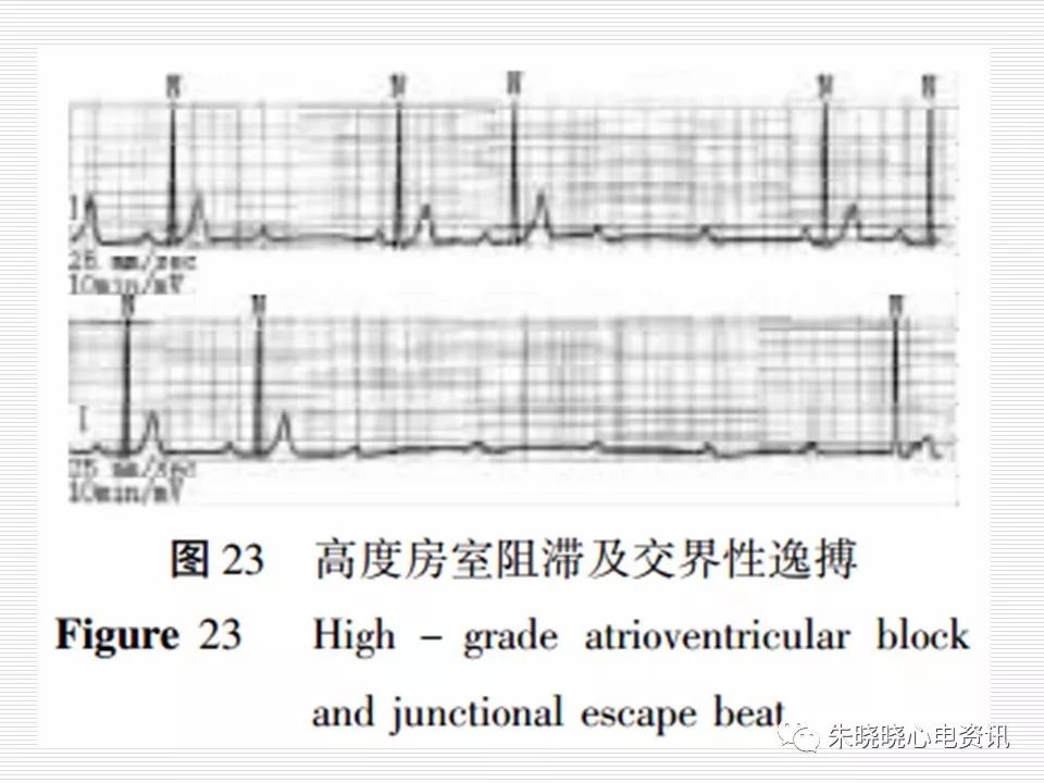 心电图危急值识别与诊断，看完我就收藏了！