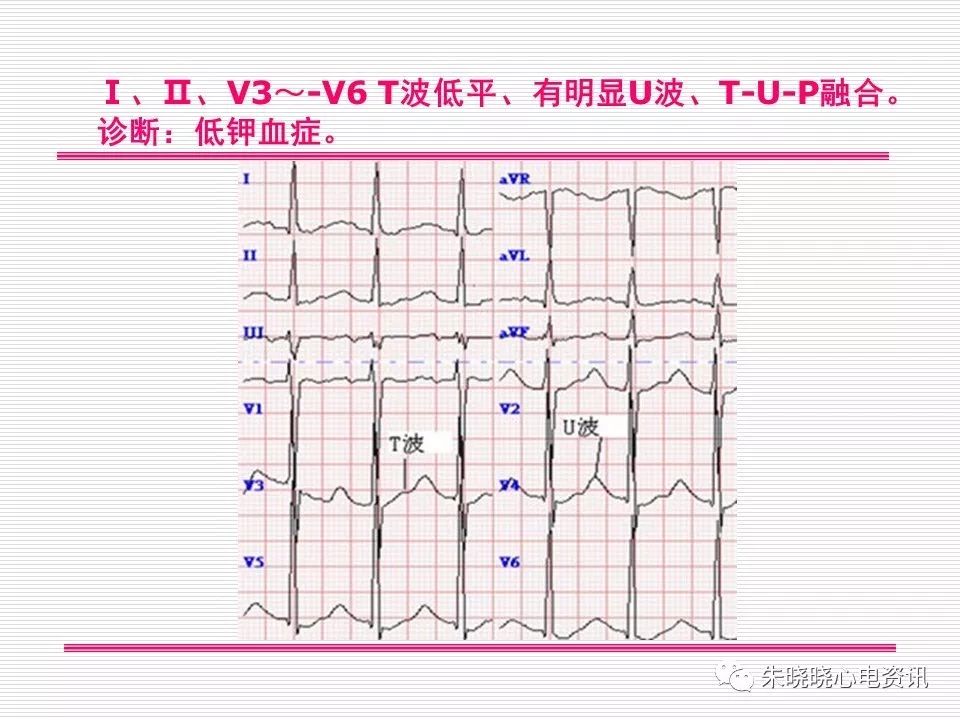 心电图危急值识别与诊断，看完我就收藏了！