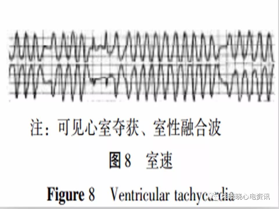 心电图危急值识别与诊断，看完我就收藏了！