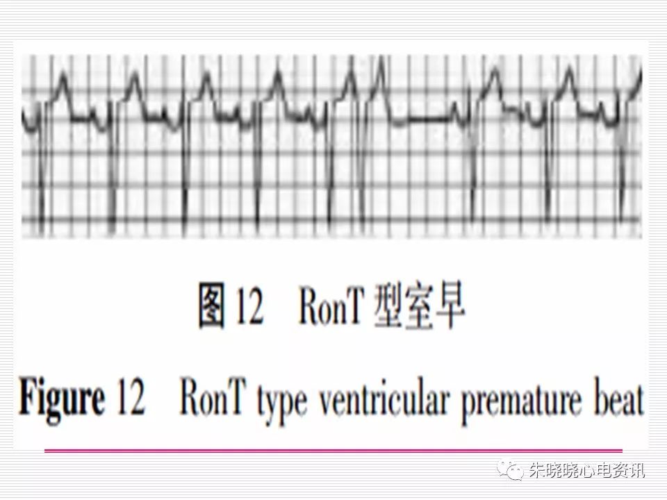 心电图危急值识别与诊断，看完我就收藏了！