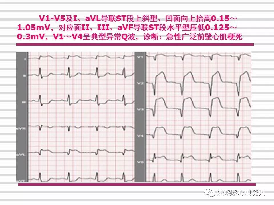 心电图危急值识别与诊断，看完我就收藏了！