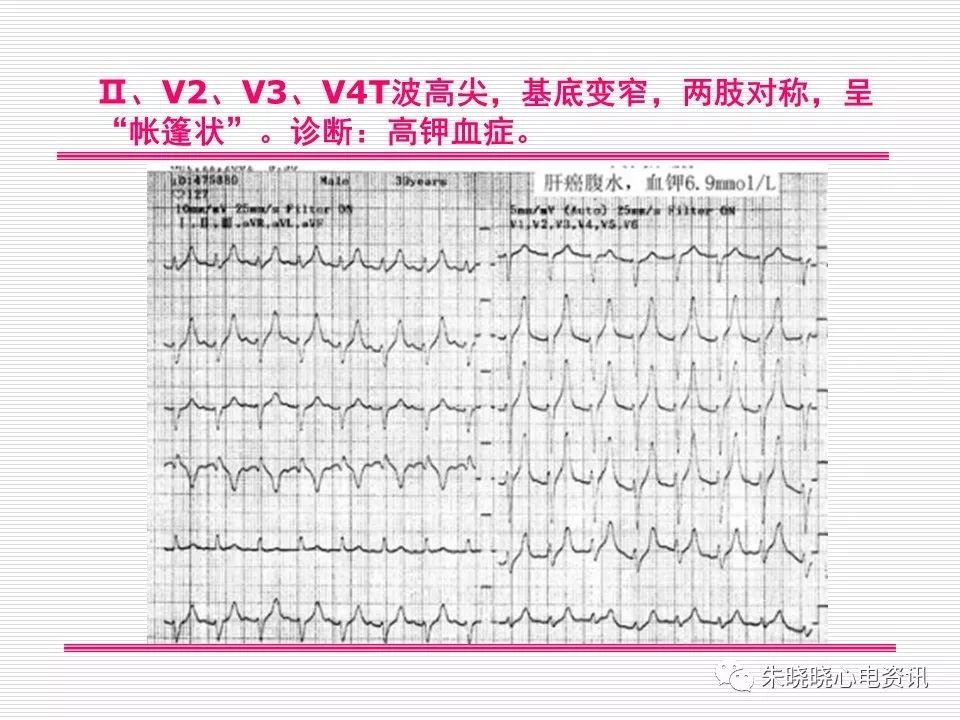 心电图危急值识别与诊断，看完我就收藏了！