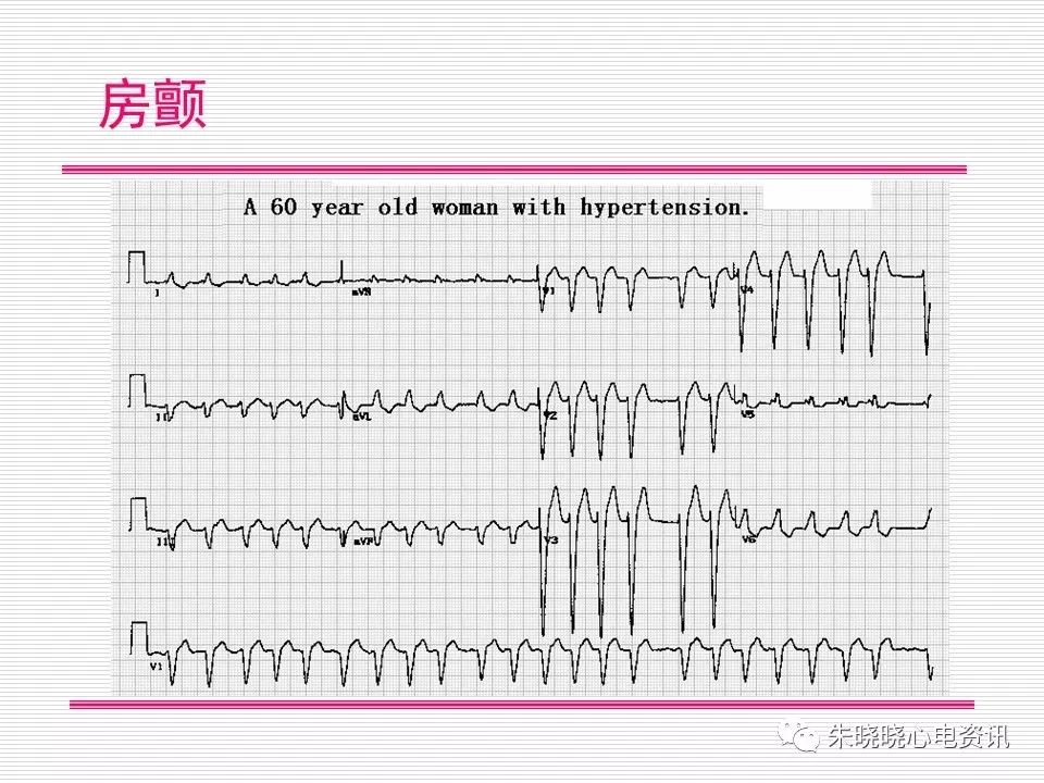 心电图危急值识别与诊断，看完我就收藏了！