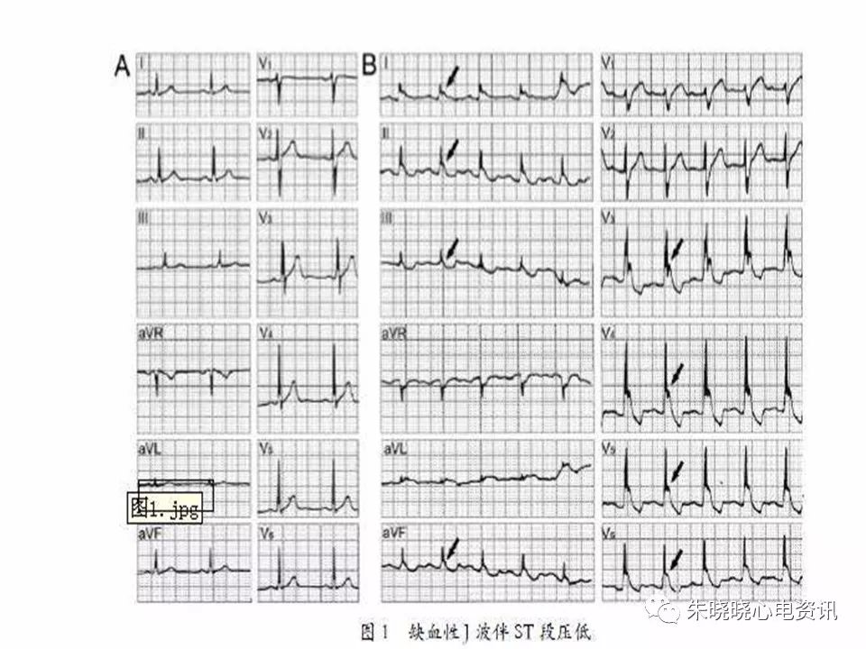 心电图危急值识别与诊断，看完我就收藏了！