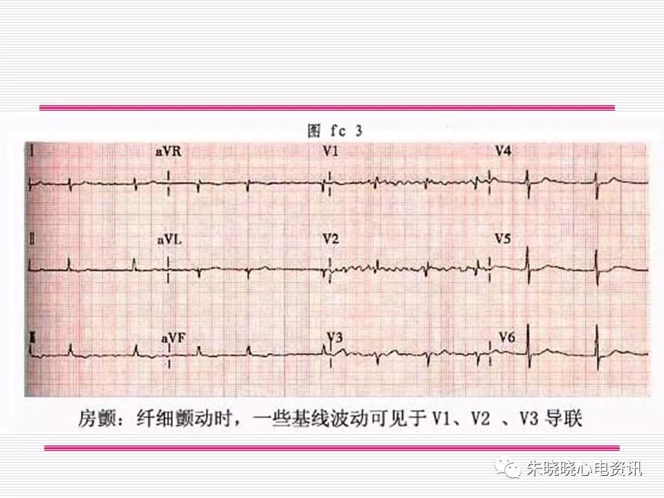 心电图危急值识别与诊断，看完我就收藏了！