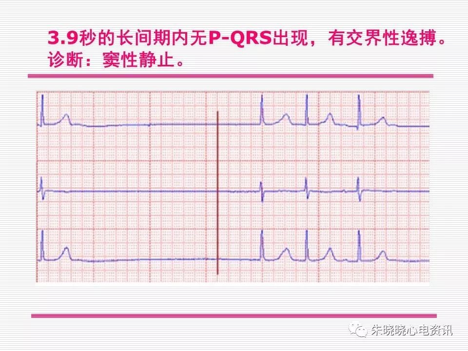 心电图危急值识别与诊断，看完我就收藏了！