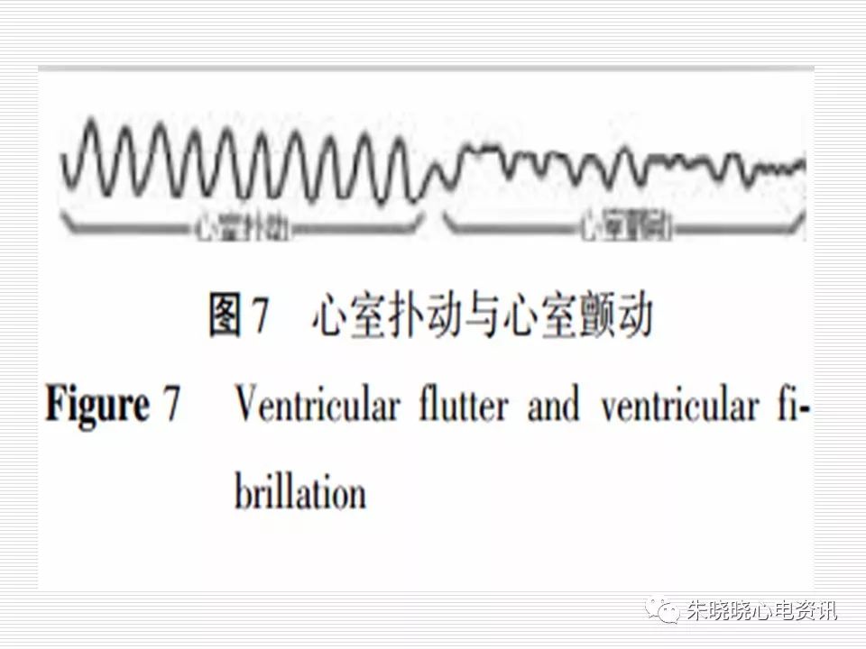 心电图危急值识别与诊断，看完我就收藏了！