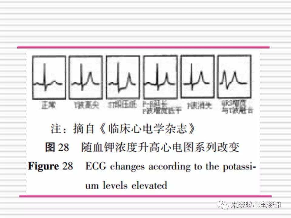 心电图危急值识别与诊断，看完我就收藏了！